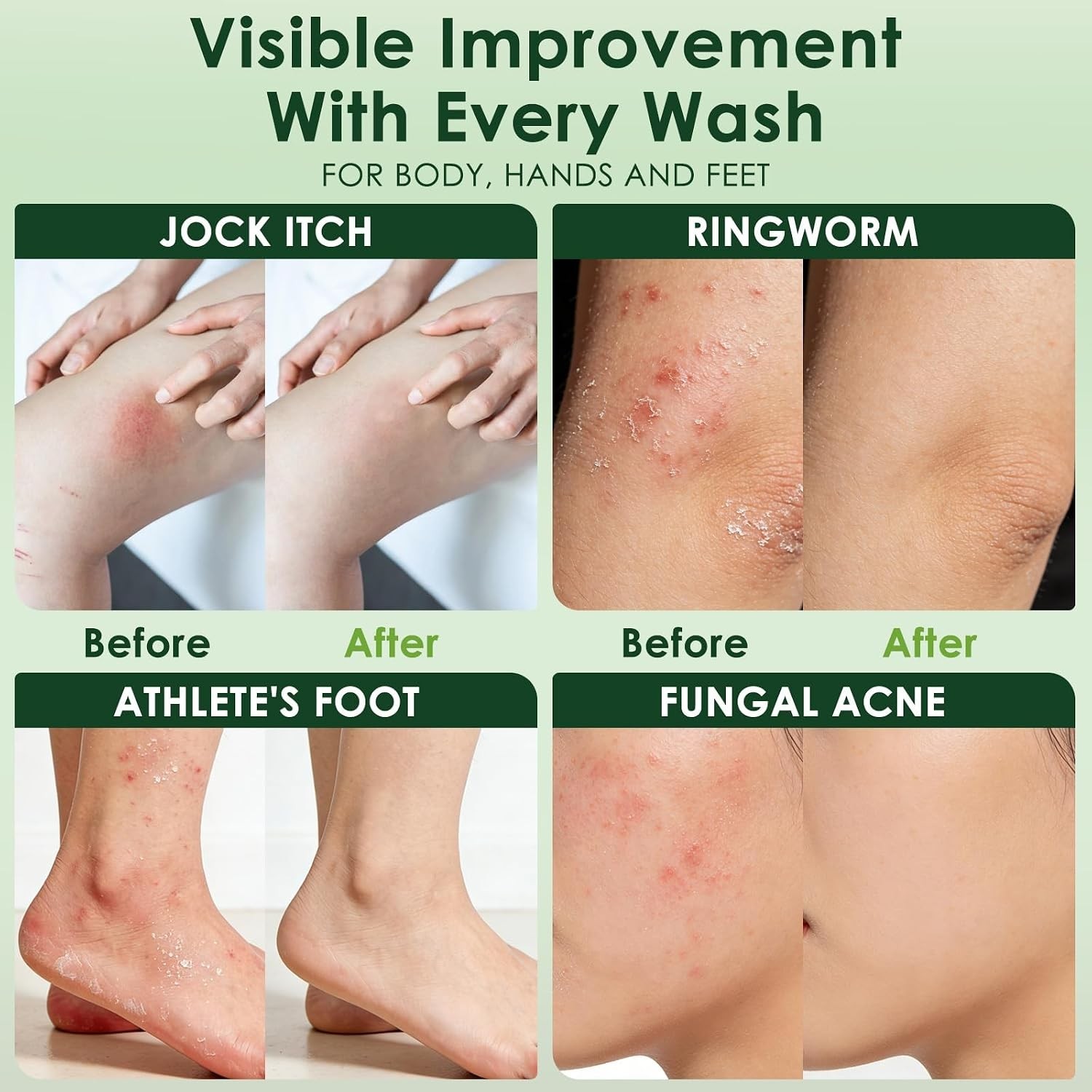 Antifungal Soap, Tea Tree Antifungal Soap Bar for Back Acne, Athlete’s Foot, …