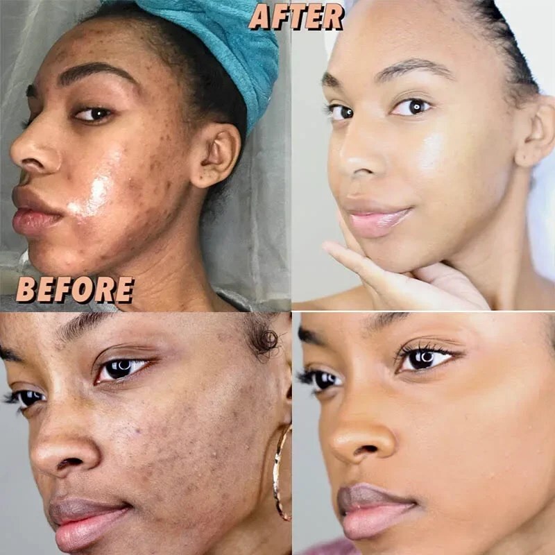 Turmeric Kojic Acid Brightening Soap Skin Whitening Dark Spot lightening Acne UK