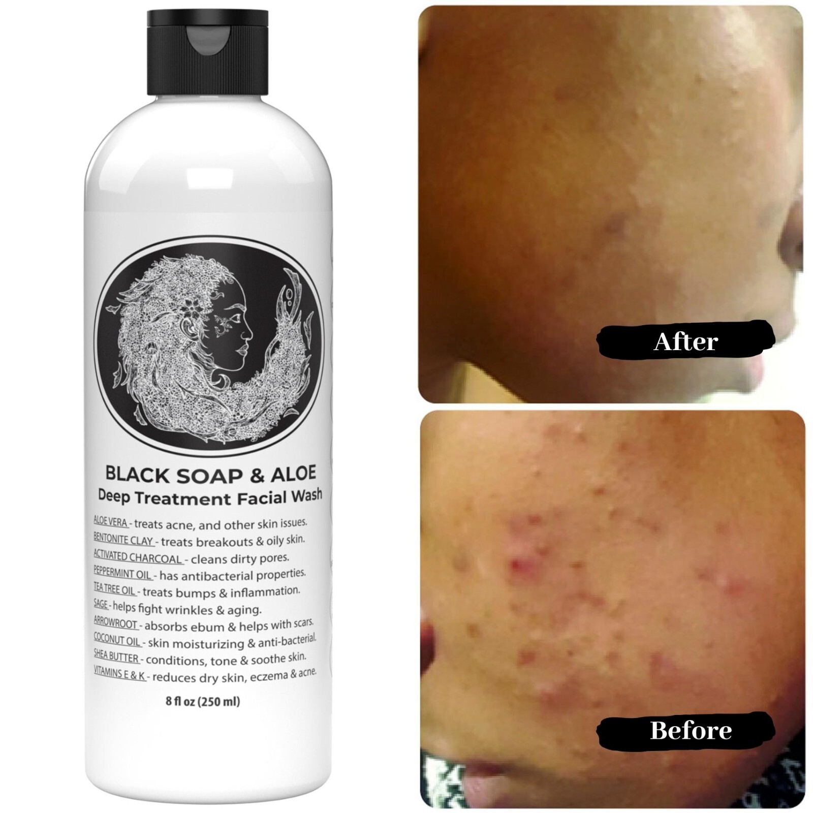 The Buyer’s Guide to Acne Soap Features