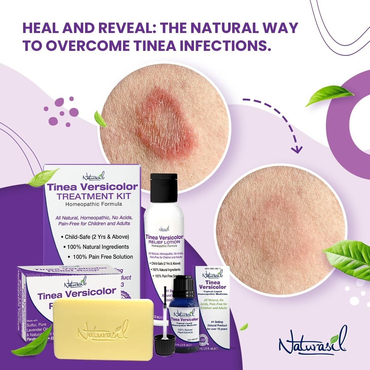 Natural Tinea Versicolor Relief Soap – Anti-Itch Sulfur Bar for Ringworm, Jock I