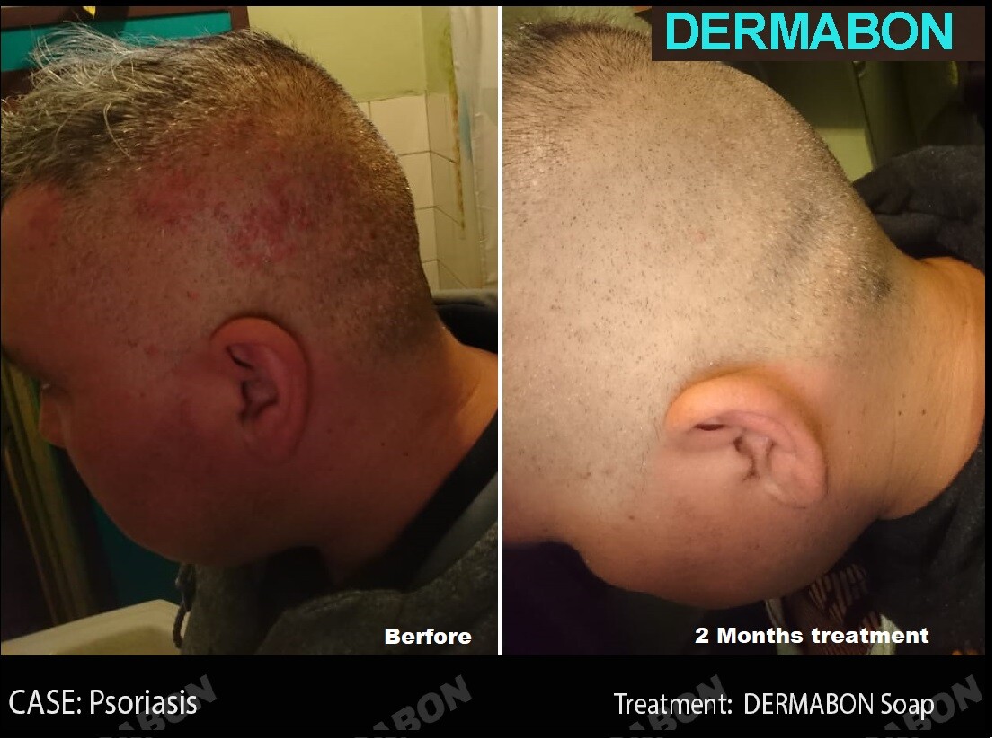 Dandruff Psoriasis Seborrheic Dermatitis 3 Pack Dermabon natural