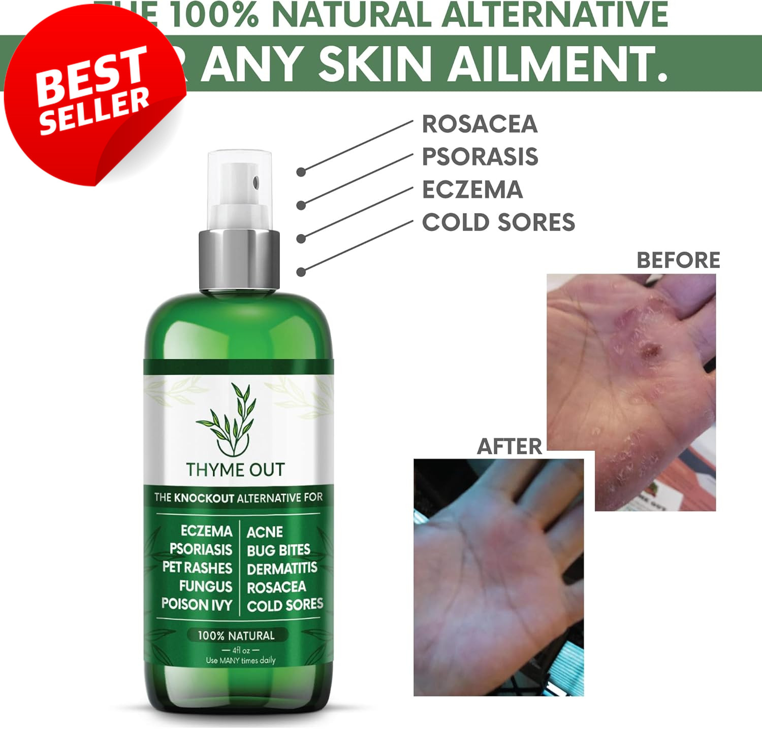 Natural Eczema Psoriasis Spray 4oz Anti-Itch Acne Rosacea Dermatitis Relief – US