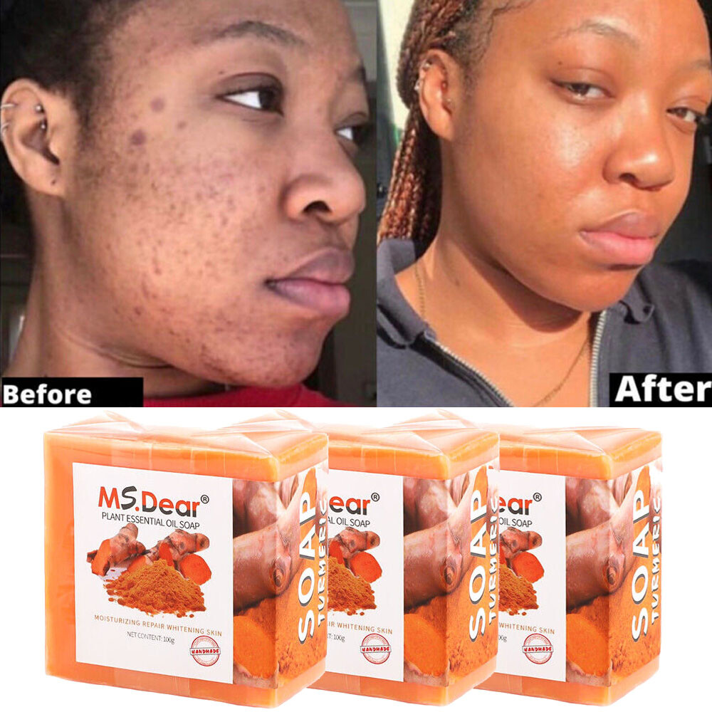 3/2Pcs Turmeric Soap Acne Dark Spots Removal Skin Whitening Body Bleaching Soaps