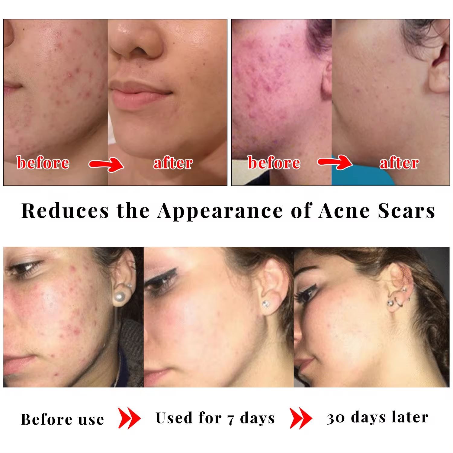 Turmeric Kojic Acid Brightening Soap Skin Whitening Dark Spot lightening Acne UK