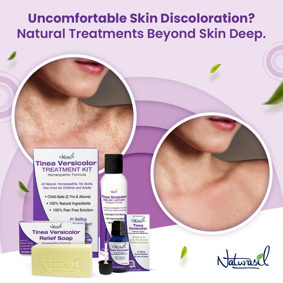 Naturasil Tinea Versicolor Soap Natural Skin Care for Itching Irritation 4oz
