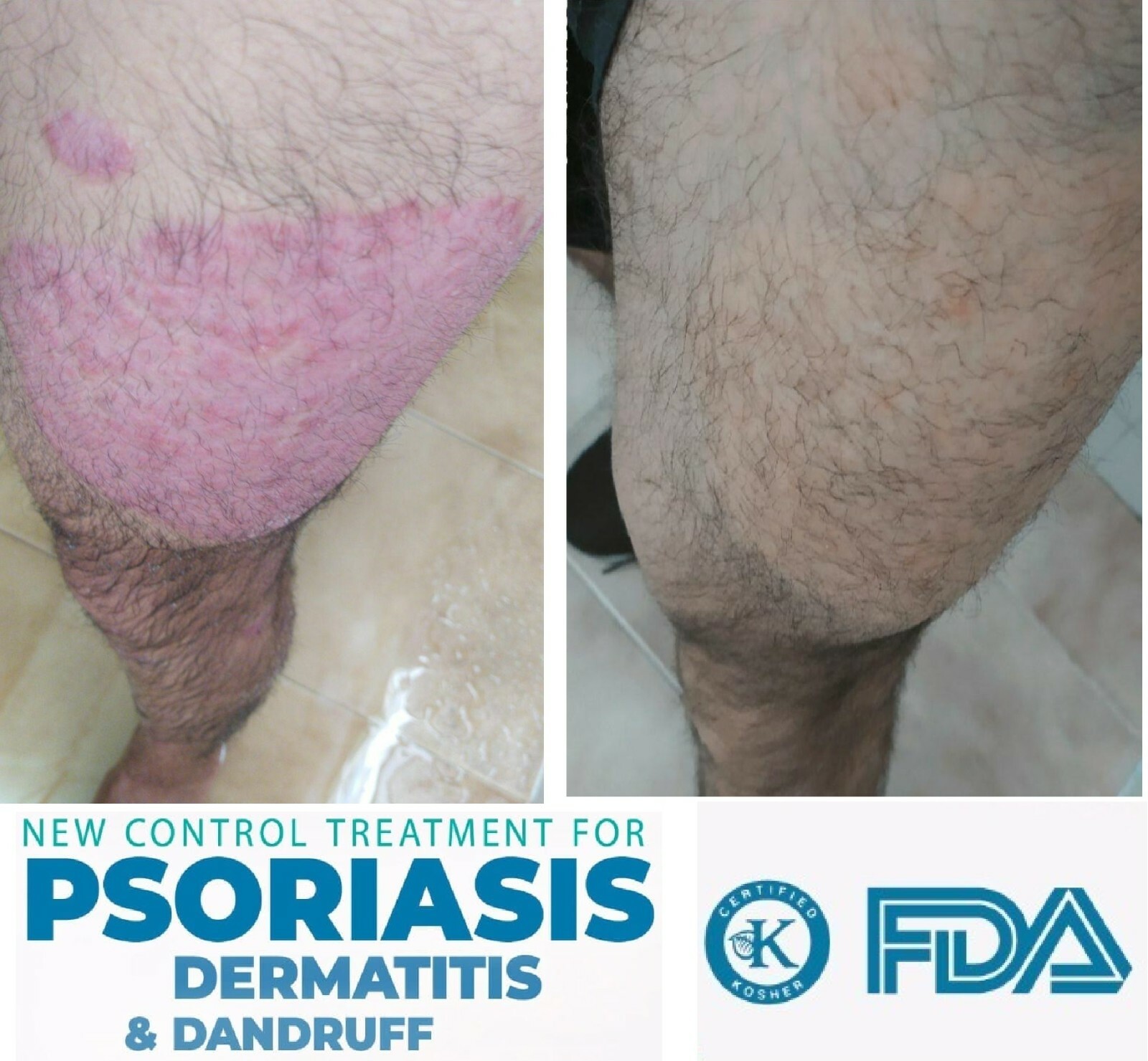 Dandruff Psoriasis Seborrheic Dermatitis 3 Pack Dermabon natural