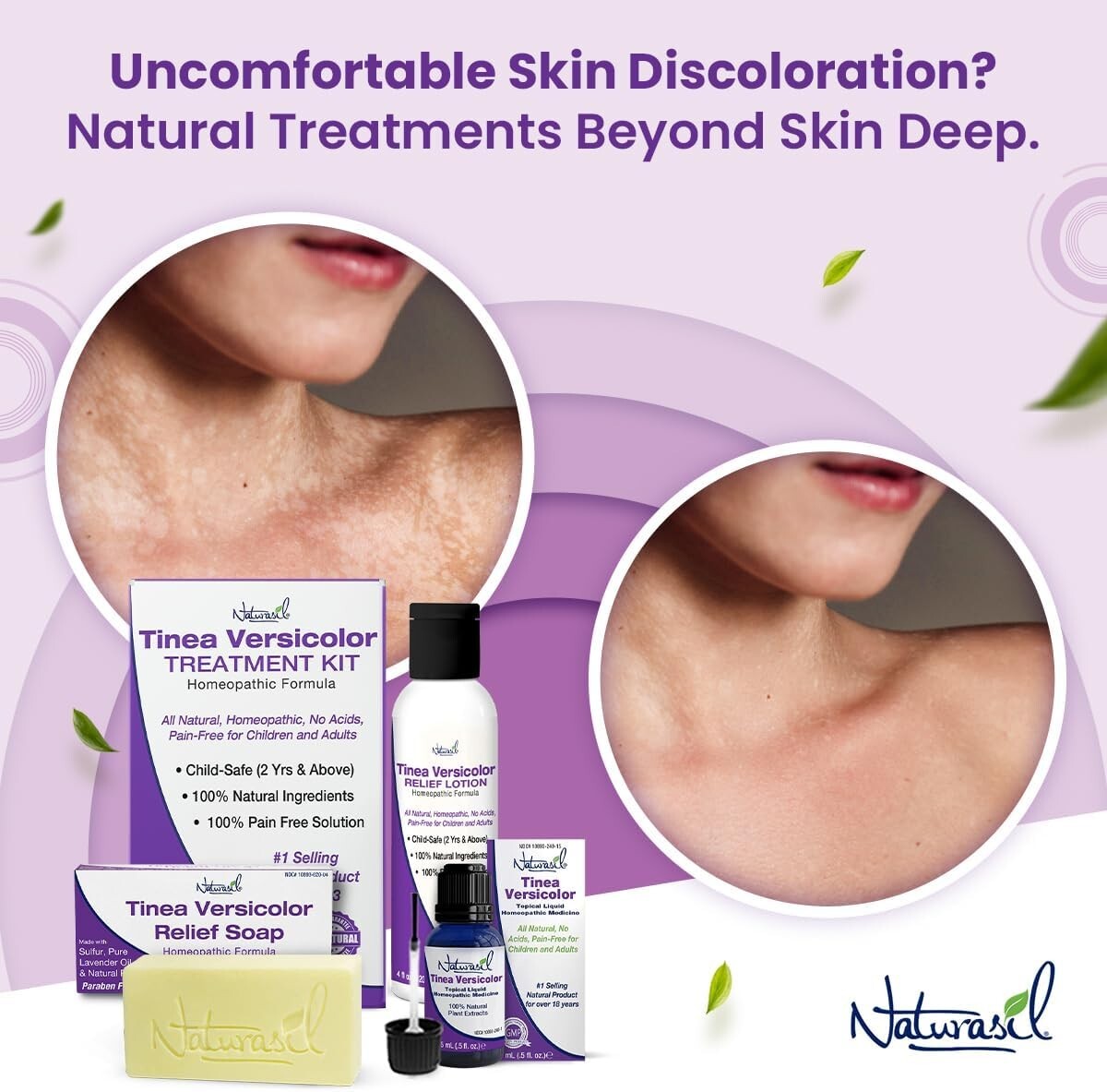 Effective Tinea Versicolor Treatment Max-Strength Soap: Fast-Acting, Kid Safe