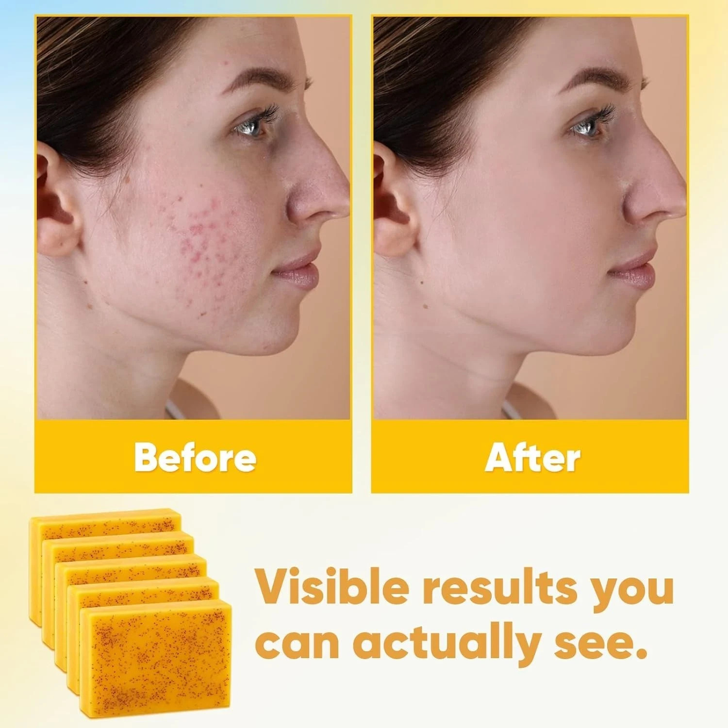 5 Jabones De Curcuma 3.5 oz Para Las Manchas El Acne En La Cara y Aclarar Piel