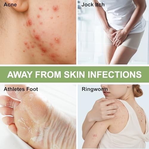 Antifungal Medicated Soap Bar, Athletes Foot Jock Itch Ringworm Yeast Infection