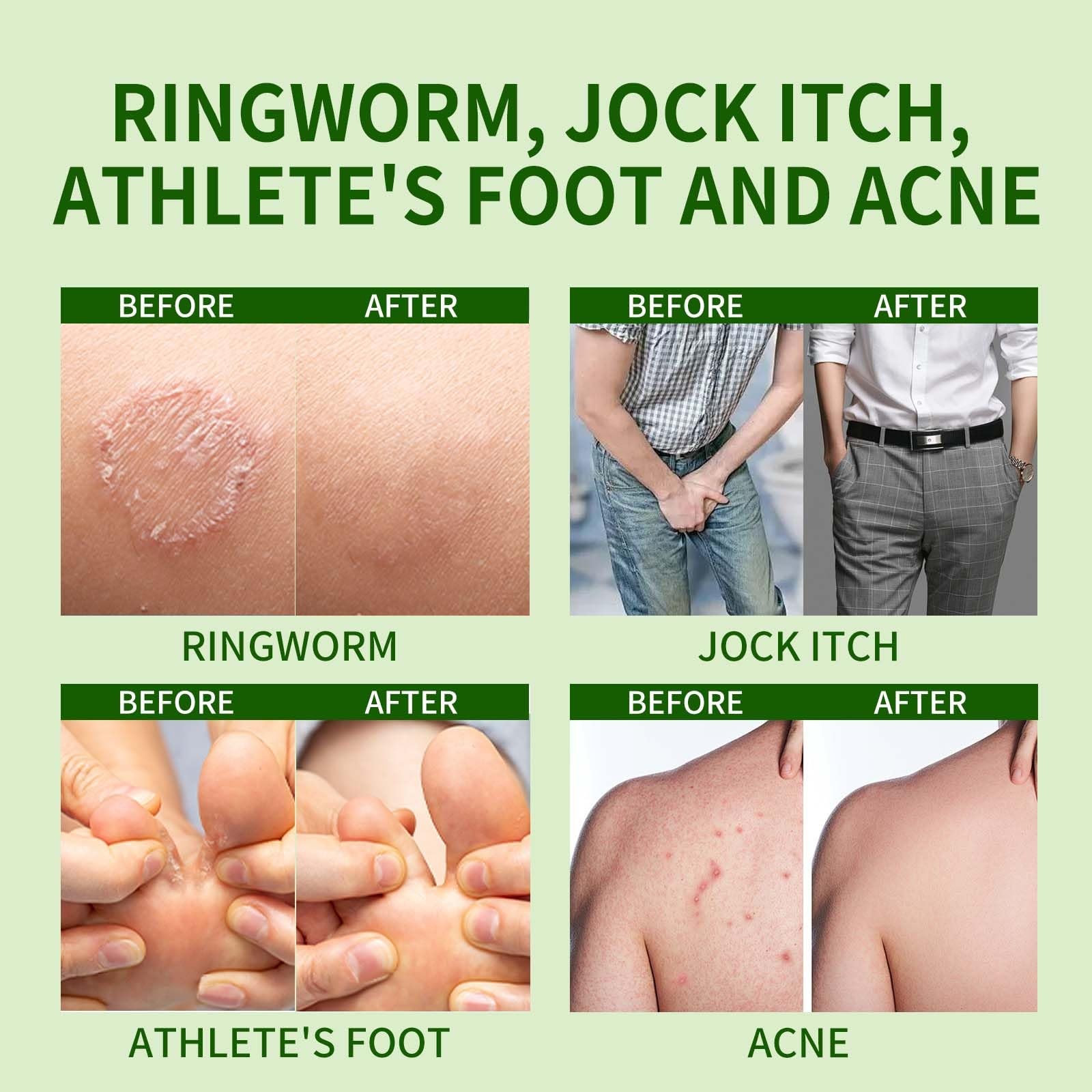 Antifungal Bar Soap – Skin Fungus Treatment for Athlete’s Foot, Jock Itch & R…