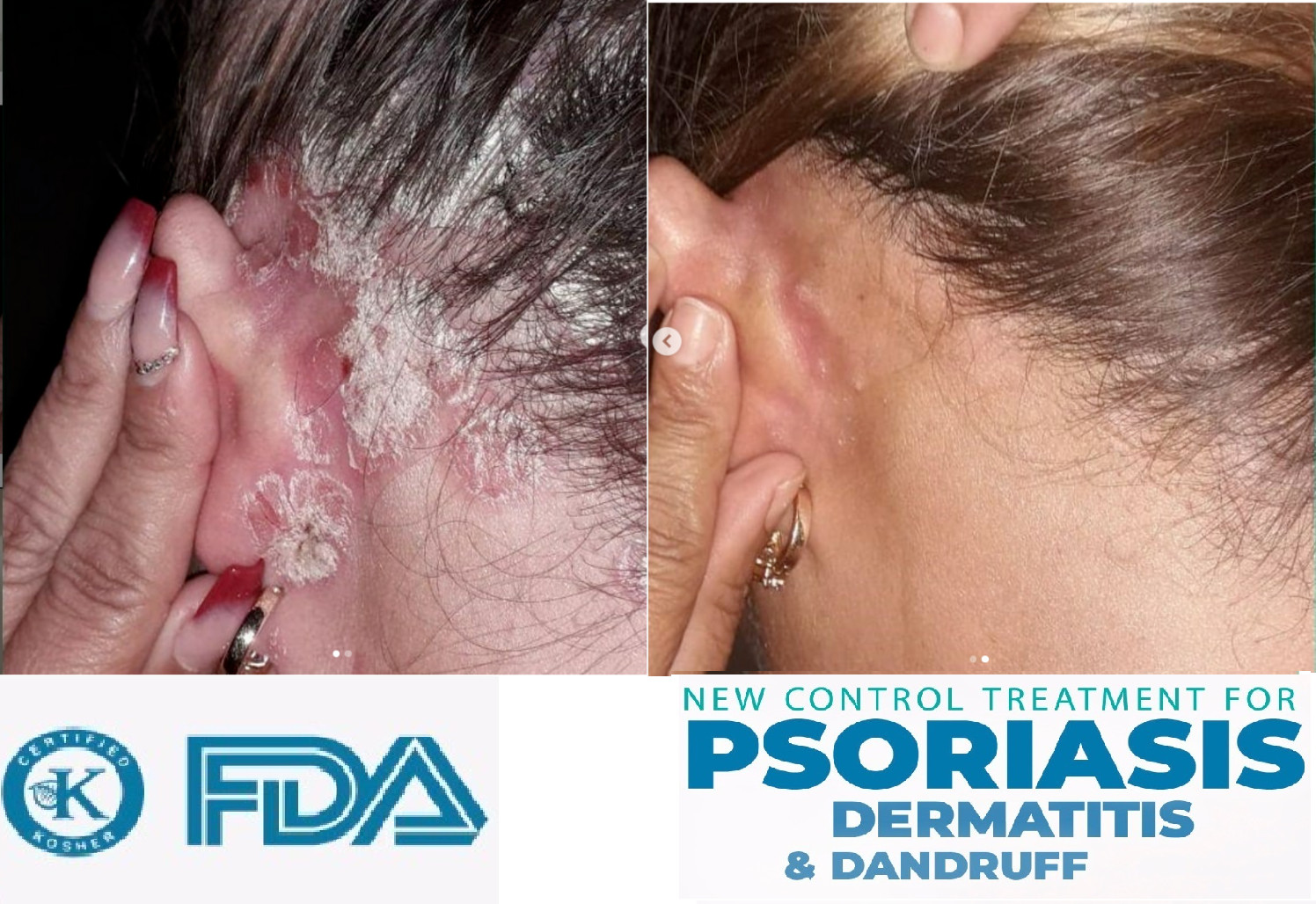 Psoriasis, Seborrheic Dermatitis and Dandruff Soap Dermabon FREE SHIPPING