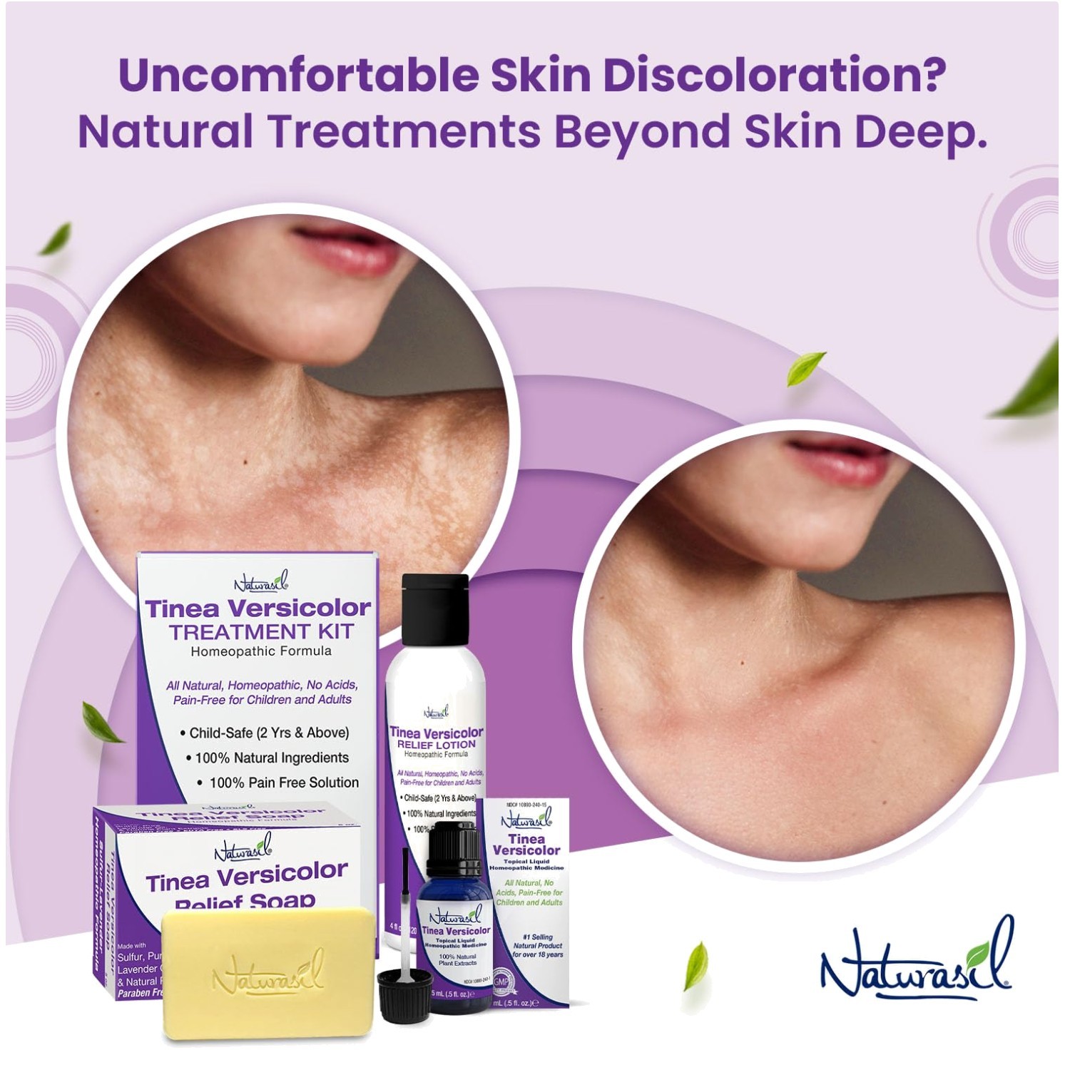 Natural Antifungal Soap for Tinea Versicolor