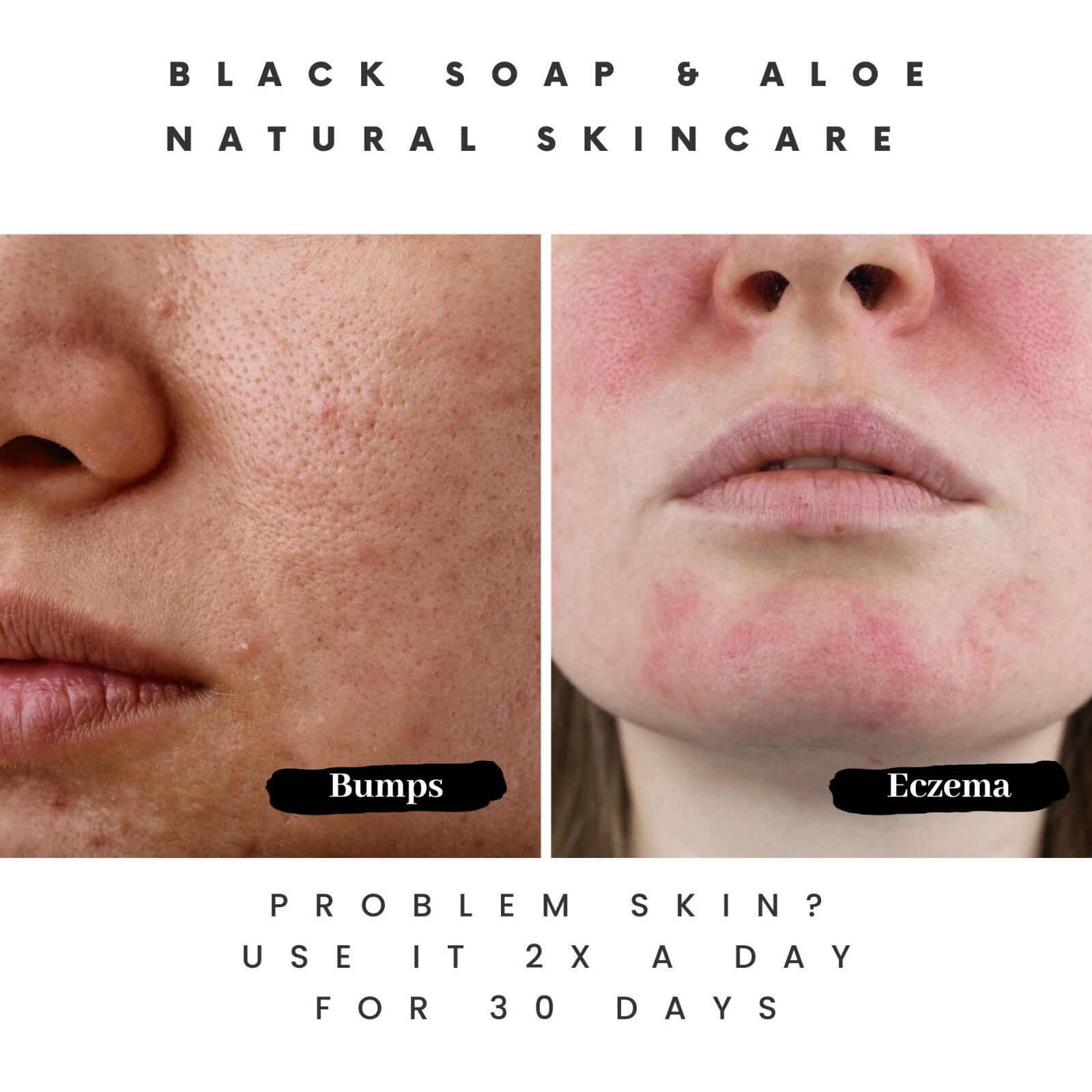 The Buyer’s Guide to Acne Soap Features