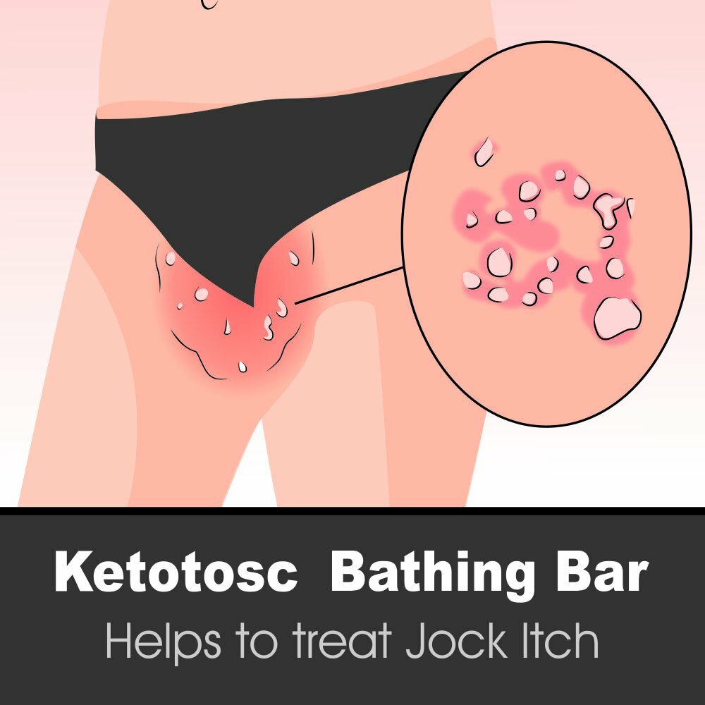 Ketotosc Antifungal & Anti Itching Soap, Good for All Types of Skin,75gm 8 pcs