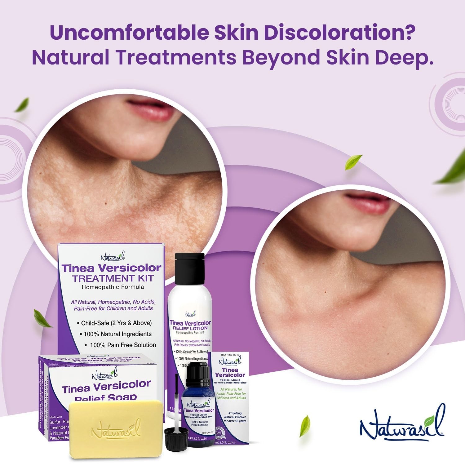 Natural Antifungal Soap for Tinea Versicolor