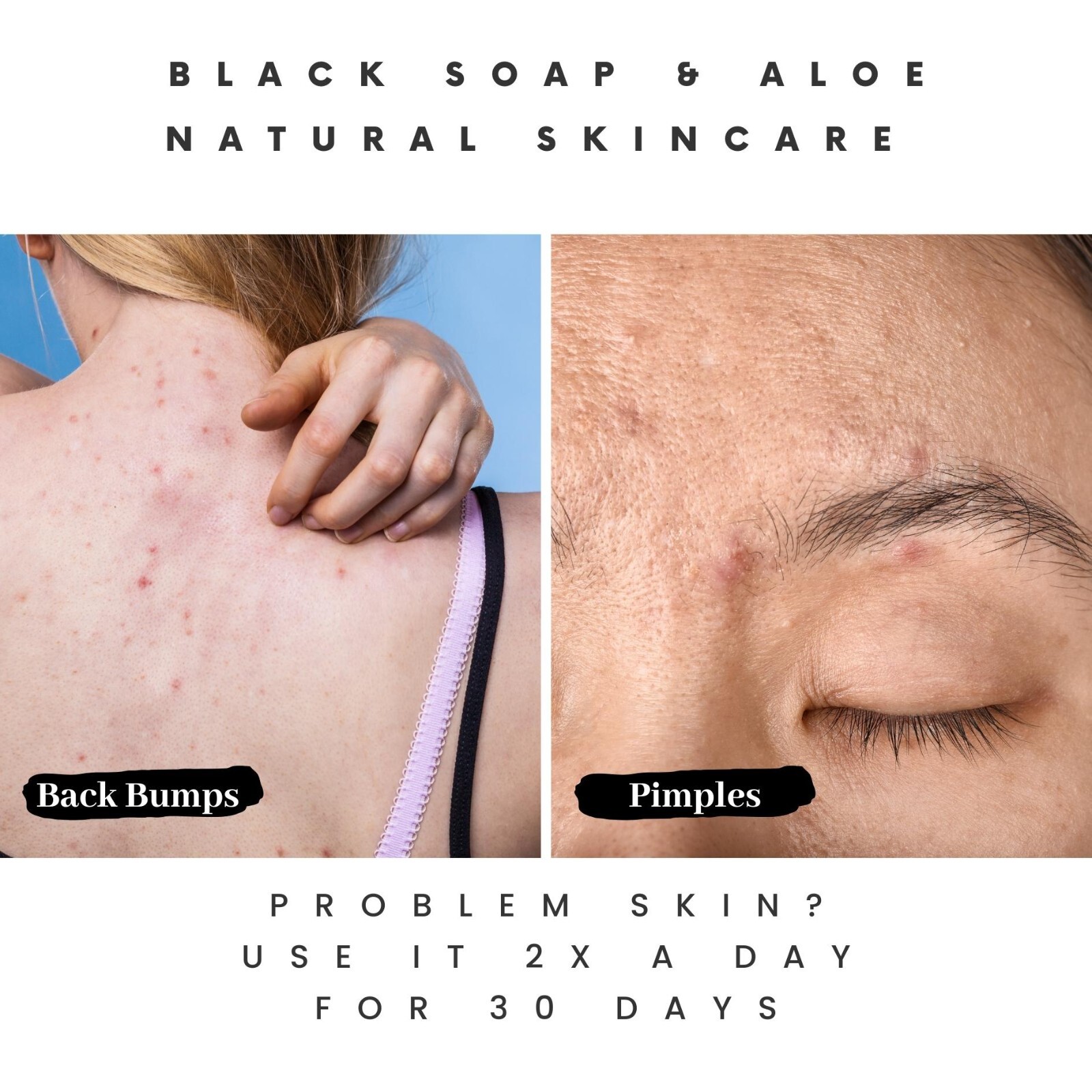 The Buyer’s Guide to Acne Soap Features