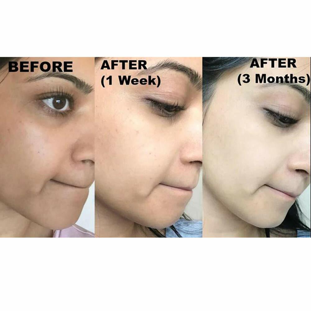 2x Kojic Acid Soap Face Body Wash Skin Cleanser Spot Corrector Acne Scar Remover