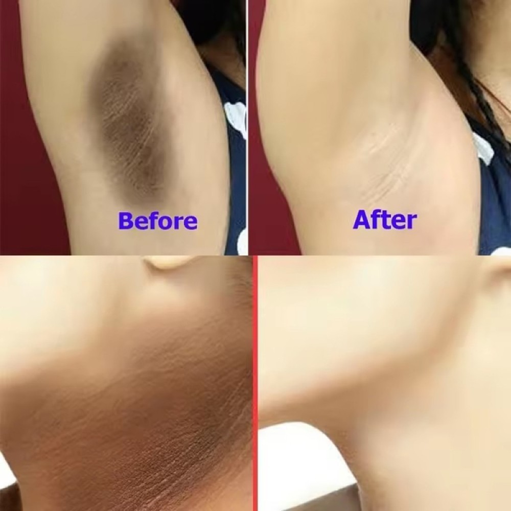 Turmeric Kojic Acid Brightening Soap Skin Whitening Dark Spot lightening Acne UK