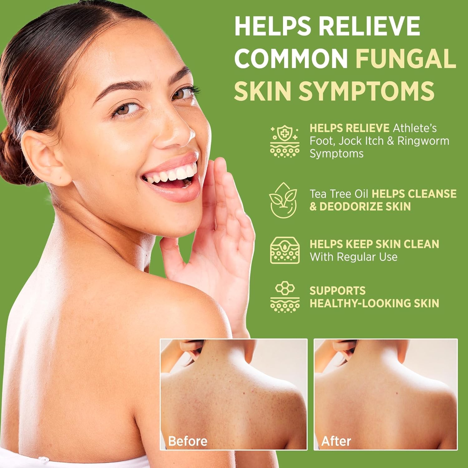 Roycederm Antifungal Antibacterial Tea Tree Soap | Treatment Soap for Face &…