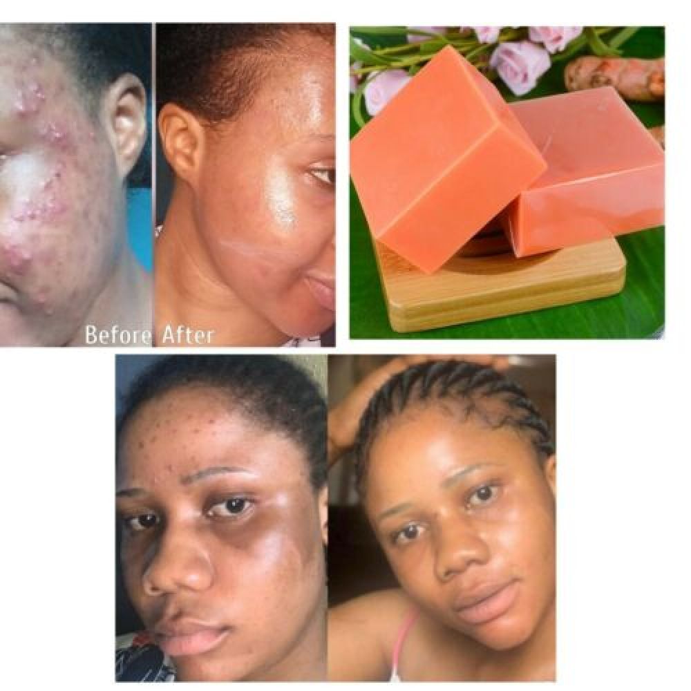 3PCS Tumeric Soap Skin Whitening Dark Spots lightening Acne Brightening Turmeric