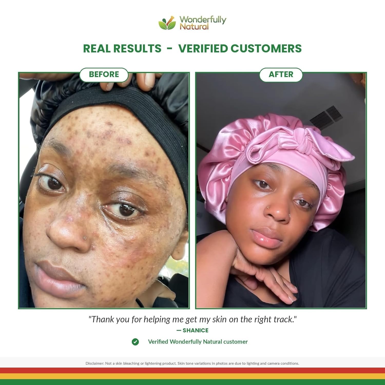 Handcrafted Organic African Black Soap – Acne & Dark Spot Treatment, 16 Ounces
