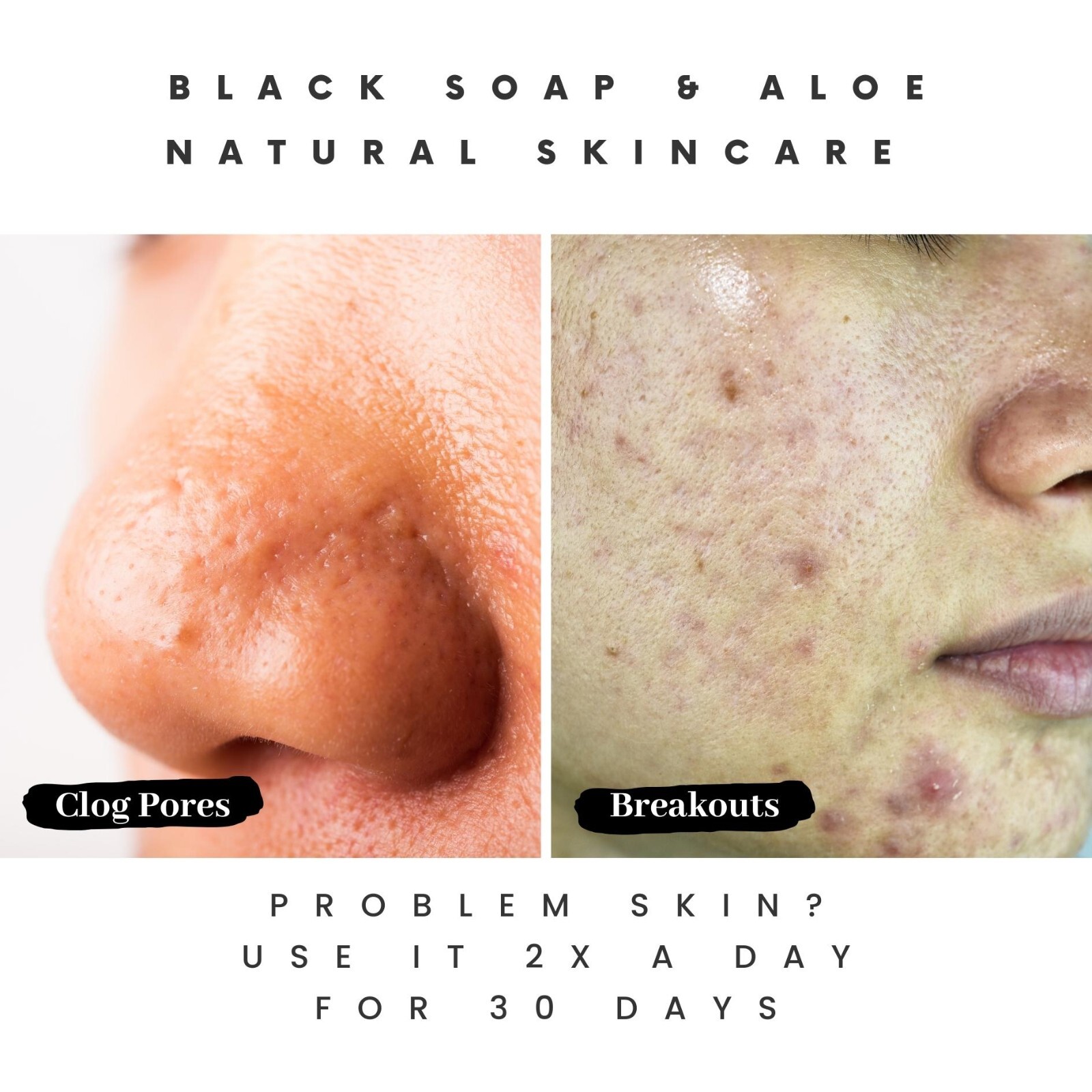 The Buyer’s Guide to Acne Soap Features