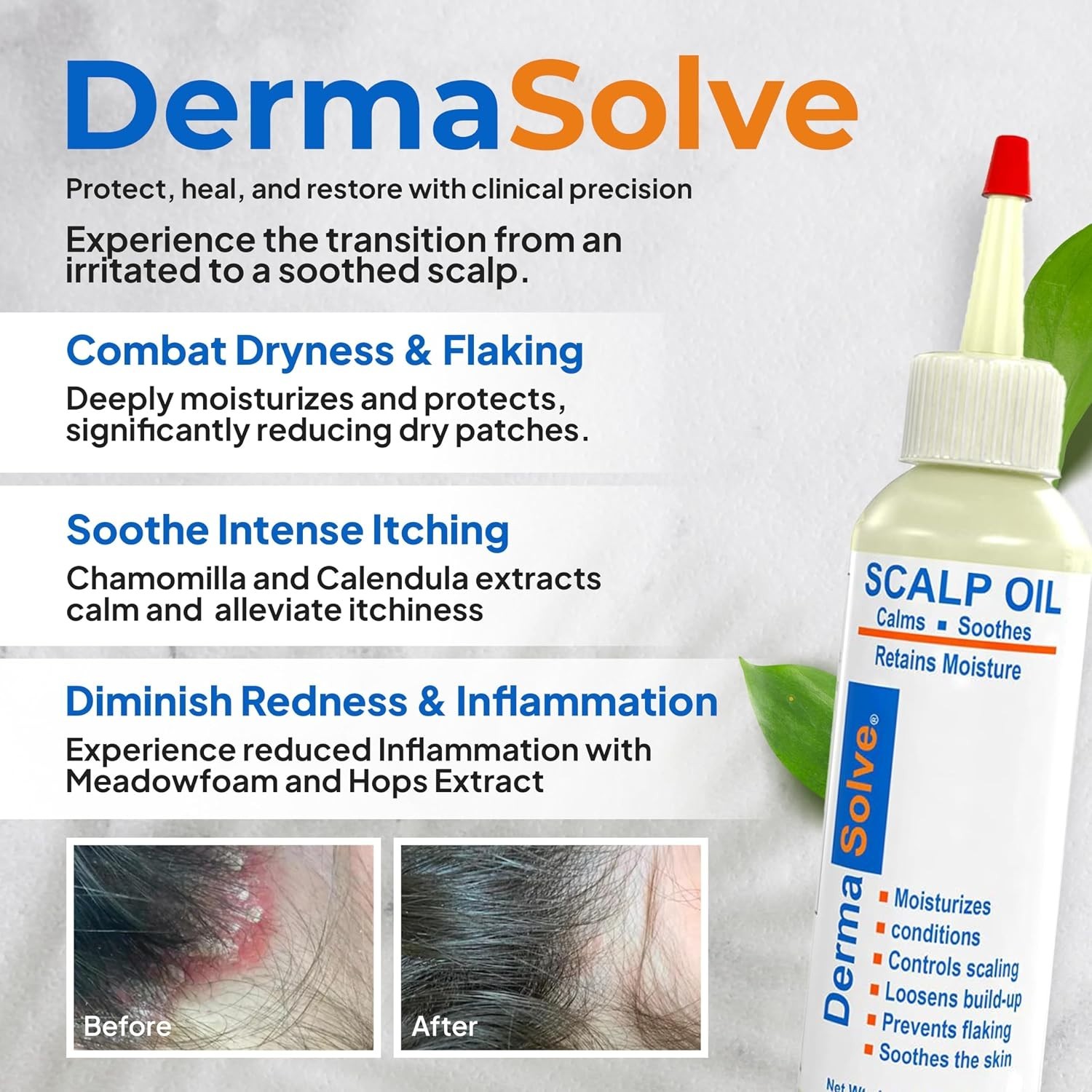 Psoriasis & Dandruff Oil, Dermatologist Approved for Flaky Scalp Relief