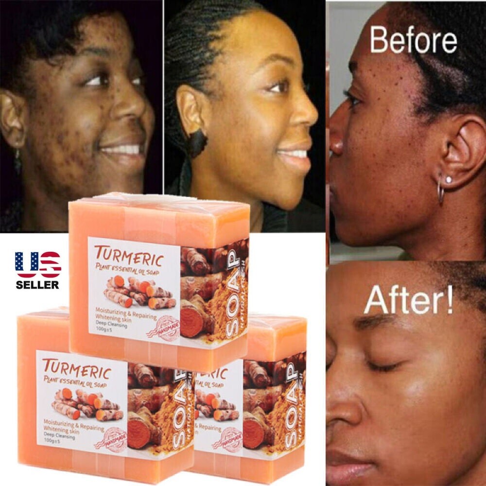 3PCS Tumeric Soap Skin Whitening Dark Spots lightening Acne Brightening Turmeric