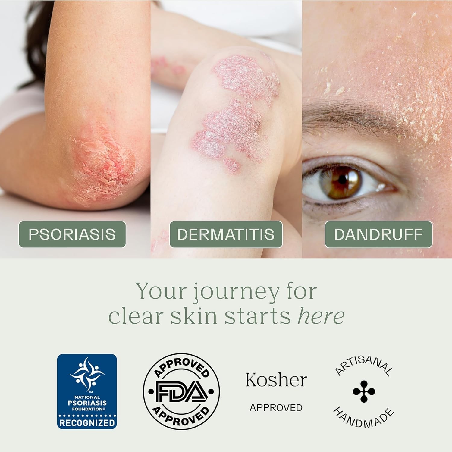 Dermabon Psoriasis Cleanser, Seborrheic Dermatitis Eczema Soap Bar for Adult…