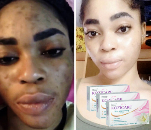Pack Of 3 Kozicare Skin Lightening Kojic Acid Soap 75 Gm Anti-Ageing Soap
