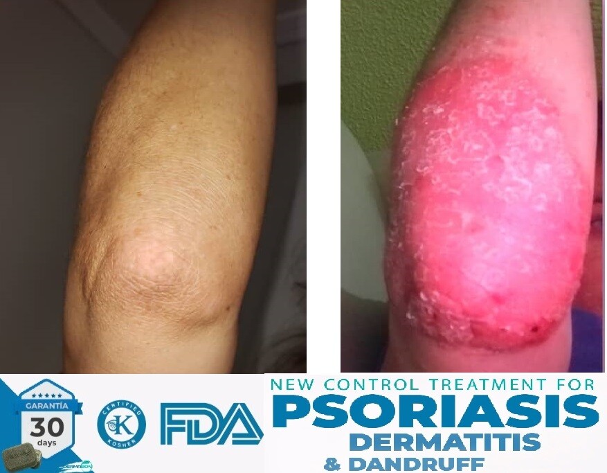 Dandruff Psoriasis Seborrheic Dermatitis 3 Pack Dermabon natural