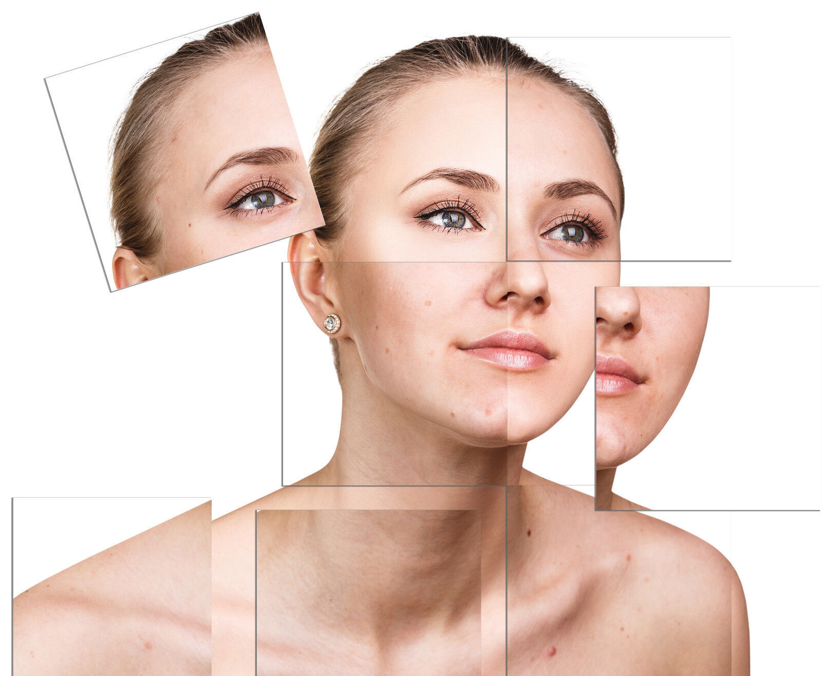 Treat Demodex Acne Rosacea Chalazion Blepharitis | Demodicosis Human Skin Mites