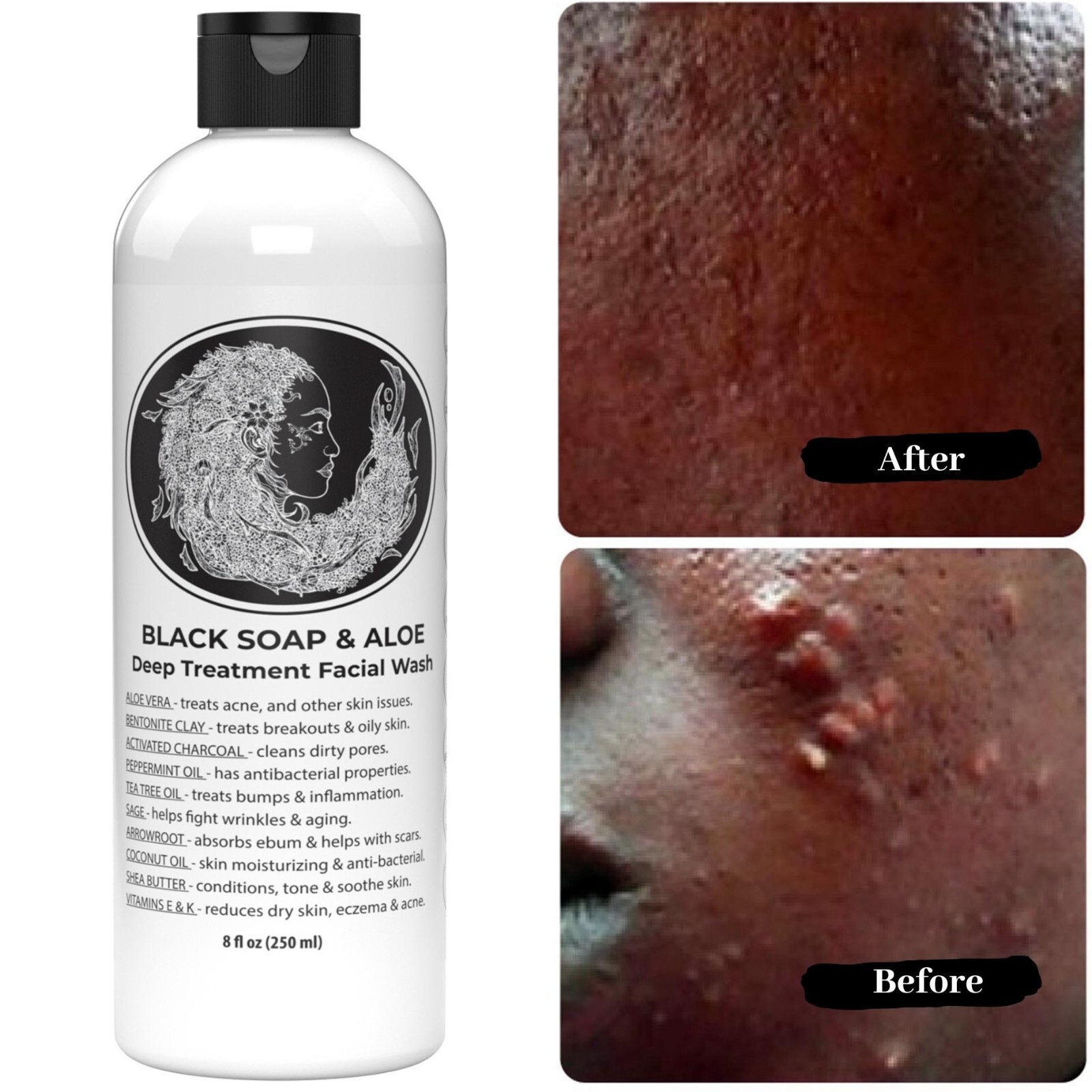 The Buyer’s Guide to Acne Soap Features