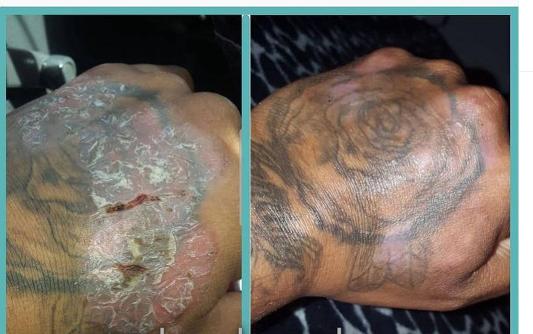 Psoriasis, Seborrheic Dermatitis and Dandruff Soap Dermabon FREE SHIPPING