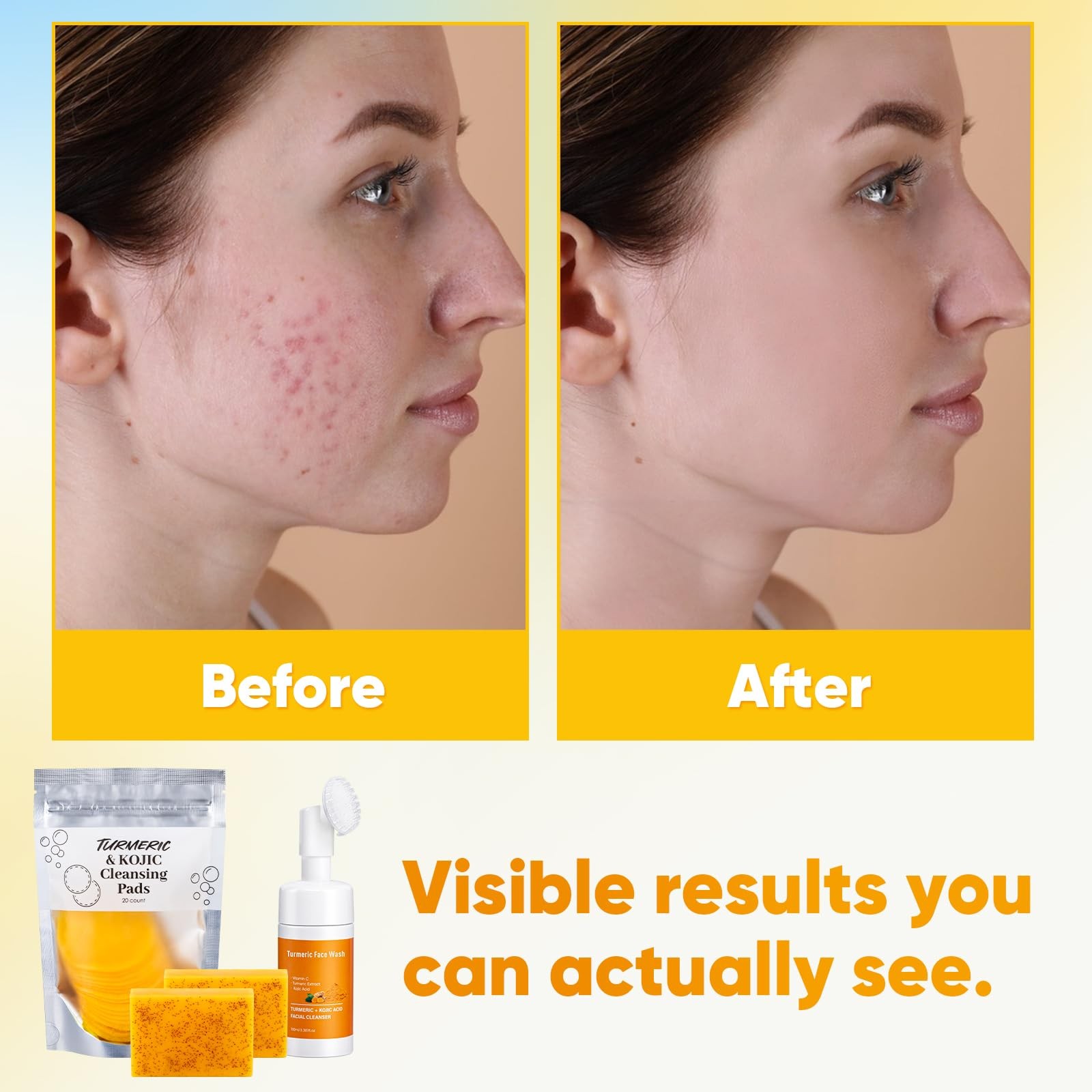 Treeroot 4Pcs Turmeric Face Wash Set: 2Pcs 70g Turmeric Kojic Acid Soap & Tur…