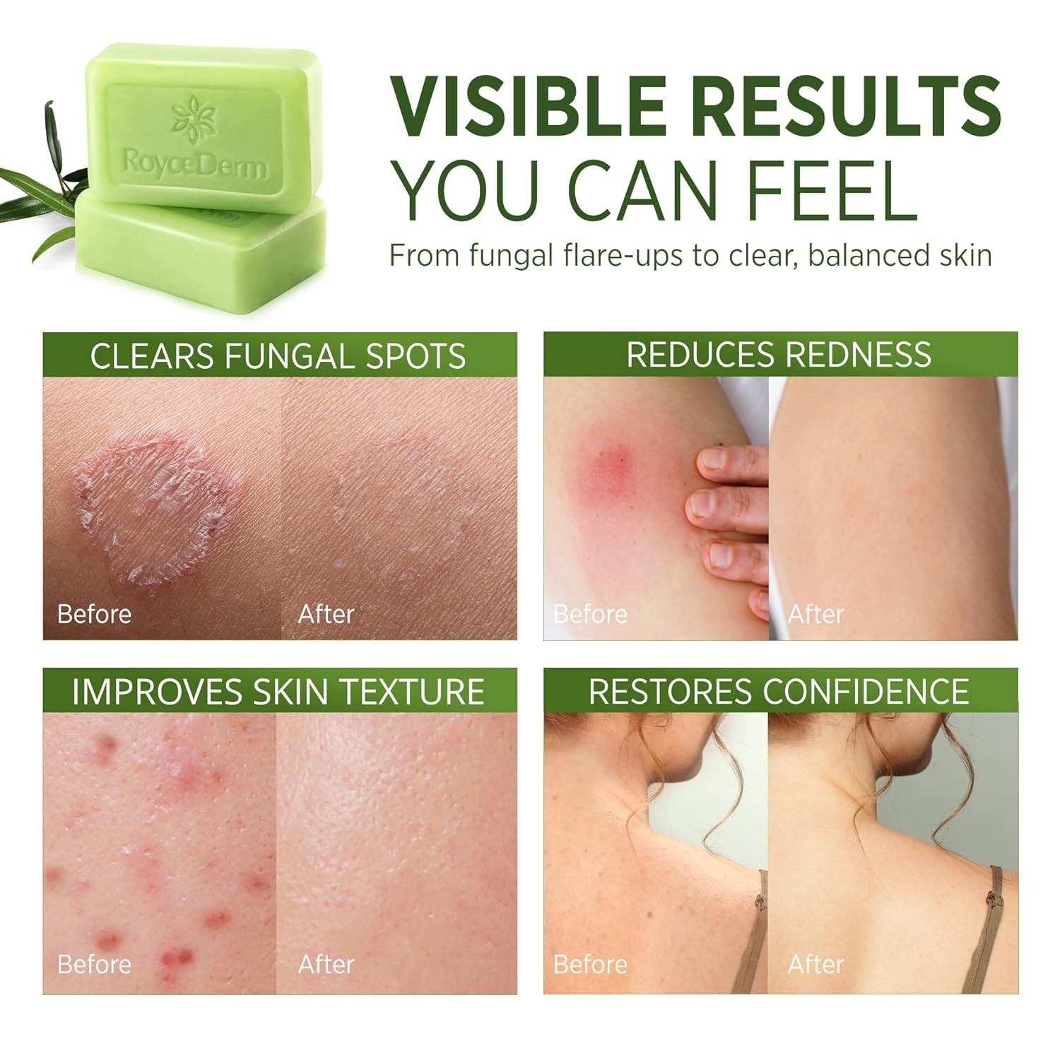 Roycederm Antifungal Antibacterial Tea Tree Soap: Antifungal Antibacterial Treat
