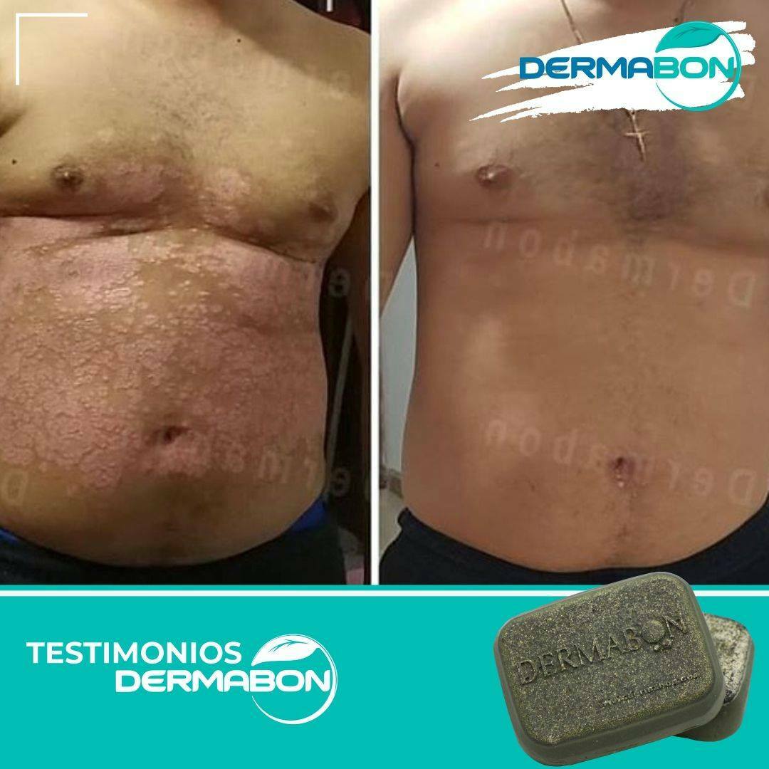 Psoriasis, Seborrheic Dermatitis and Dandruff Soap Dermabon FREE SHIPPING