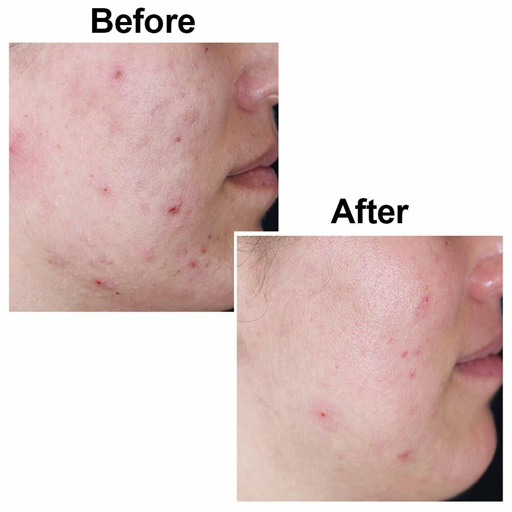 2x Kojic Acid Soap Face Body Wash Skin Cleanser Spot Corrector Acne Scar Remover