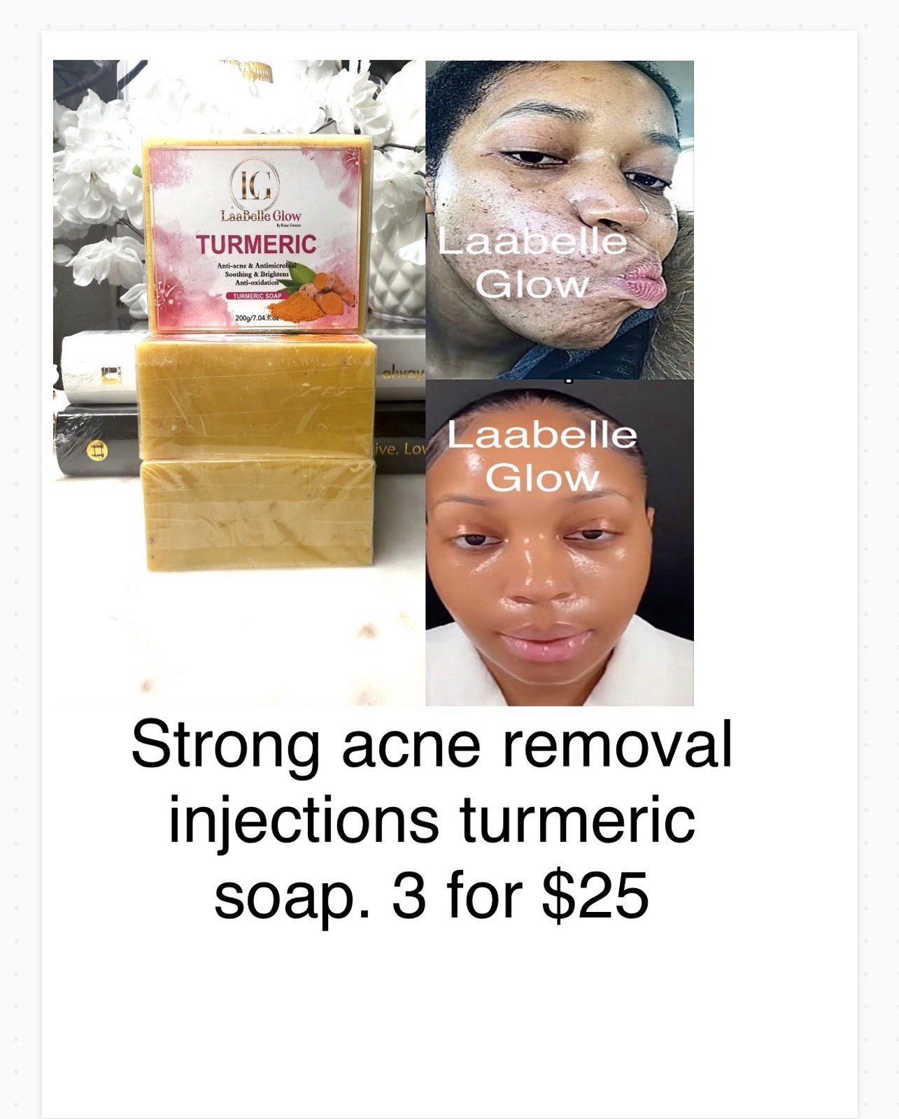 3x-Turmeric Dark Spot Acne Removal Whitening Soaps Skin 200G Medicated Acne Soap