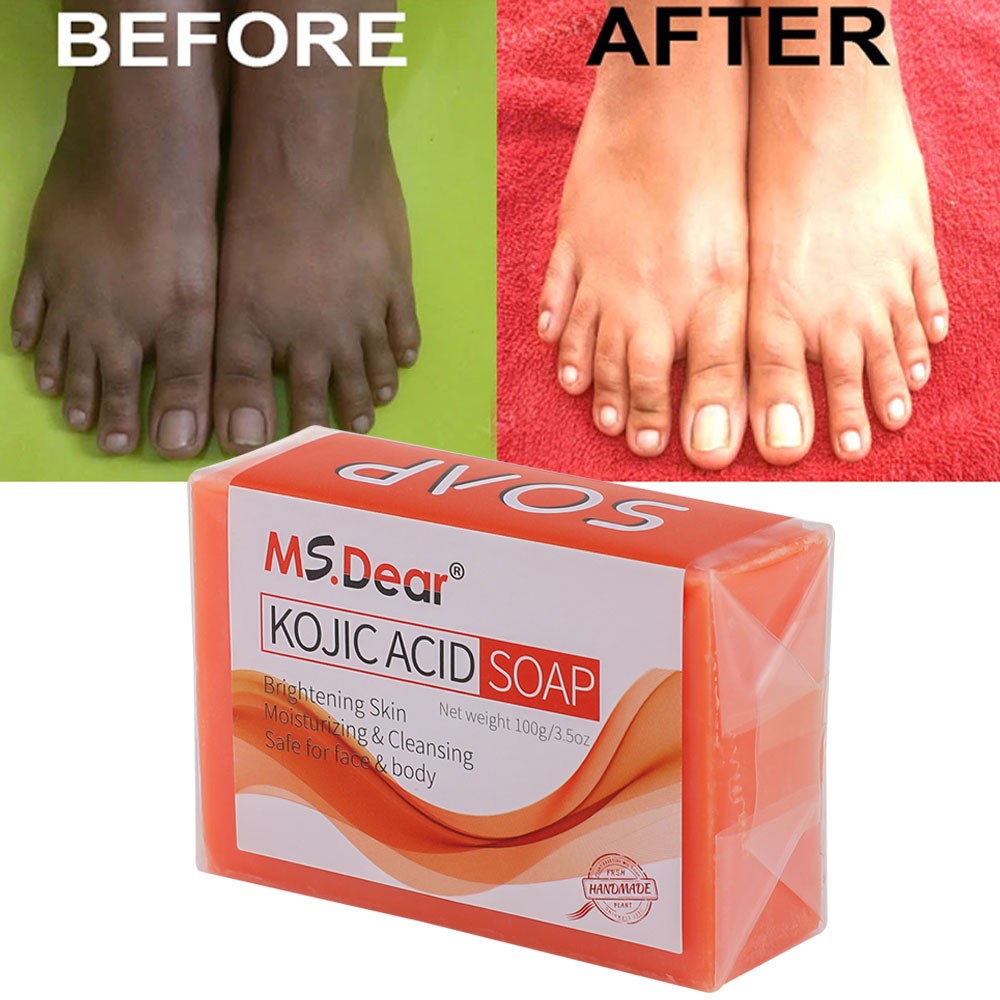 5/3X Kojic Acid Soap Acne Dark Spot Remover Skin Lightening Whitening Face Body