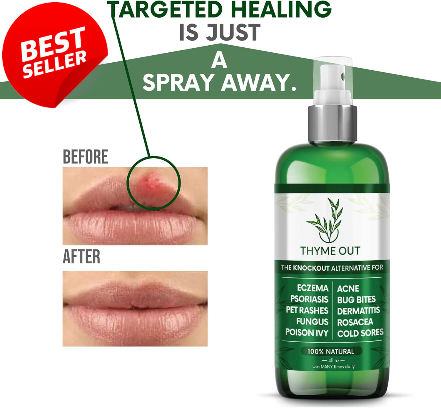 Natural Eczema Psoriasis Spray 4oz Anti-Itch Acne Rosacea Dermatitis Relief – US